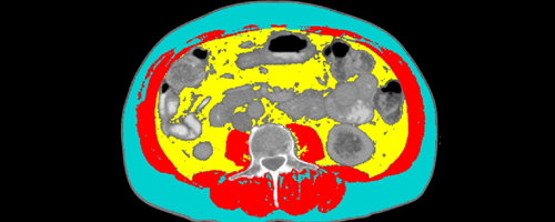 NUTRIM research - Cancer Cachexia