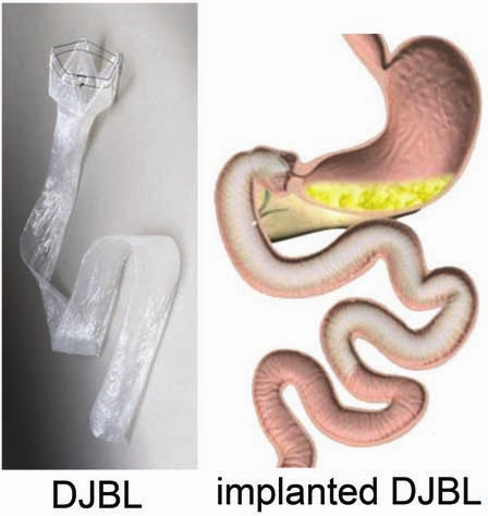 DJBL and implanted DJBL