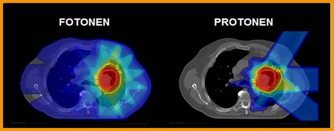 Dosisverdeling fotonen vs protonen