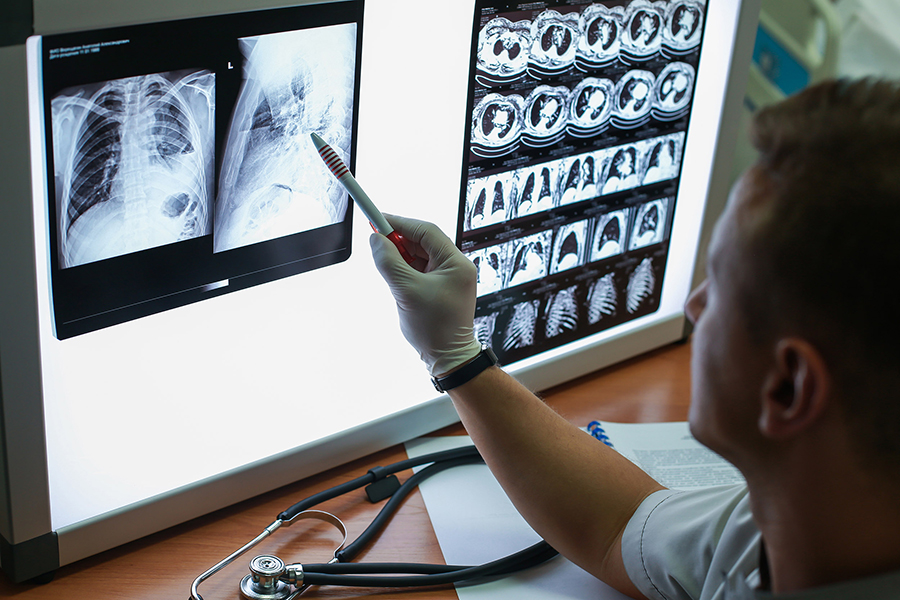 AI and radiology research into lung tumours