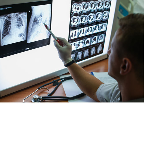 Doctor assessing a series of lung x-ray photos
