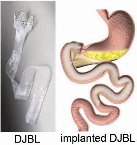 Obesity treatment