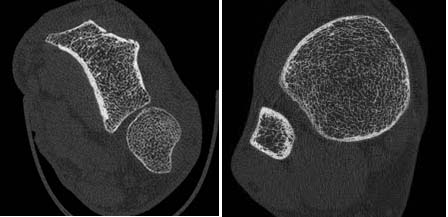 HR-pQCT images of the distal radius and tibia
