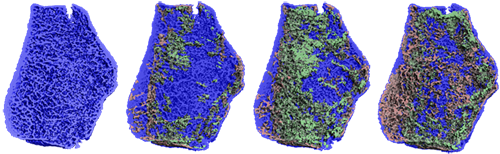 Bone gain and loss