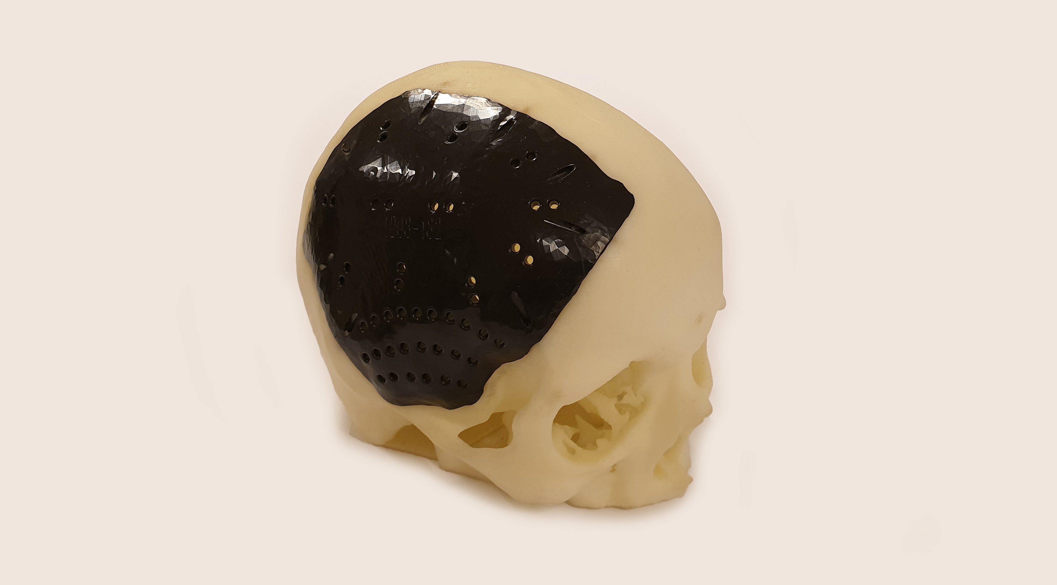 skull implant