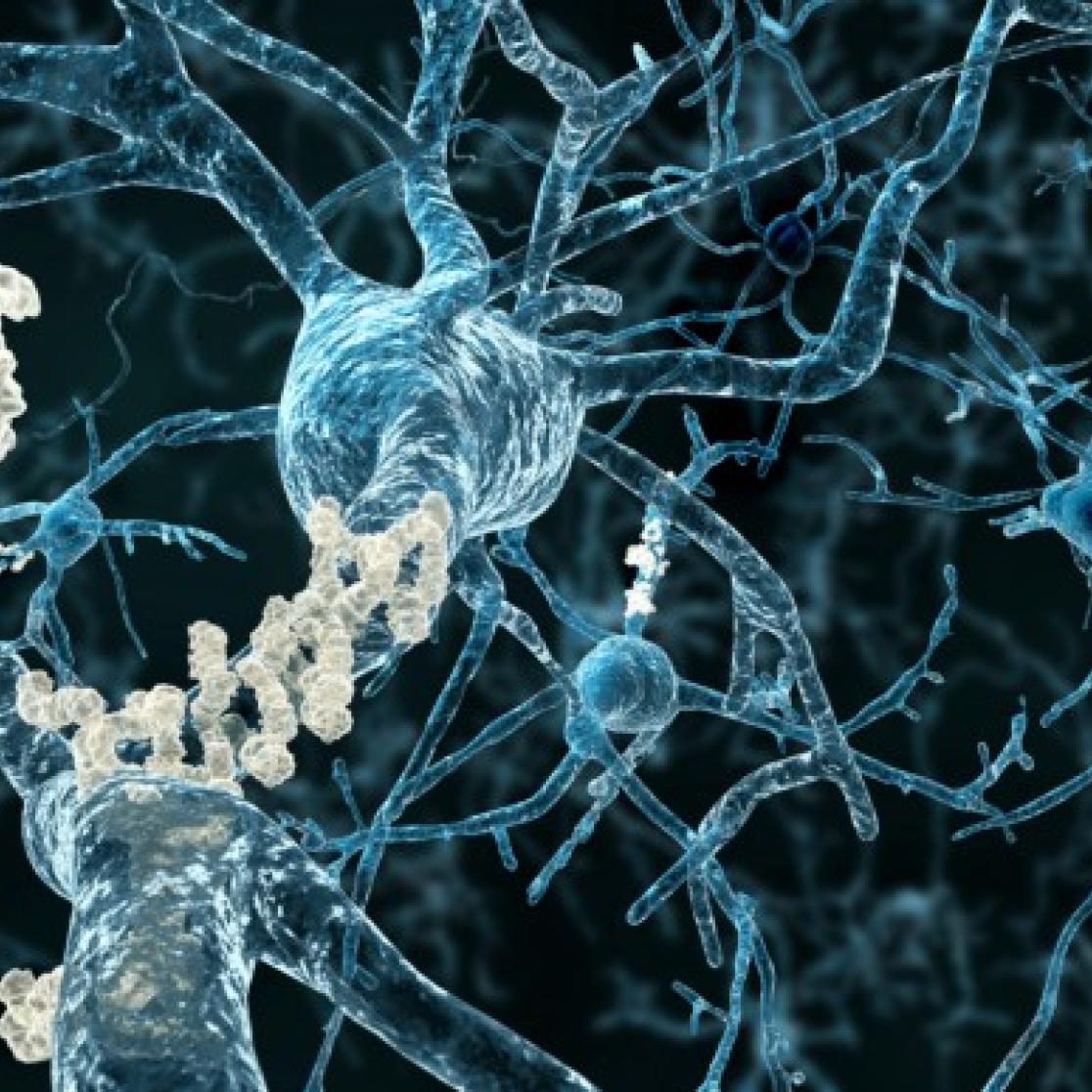 Alzheimer Plaques