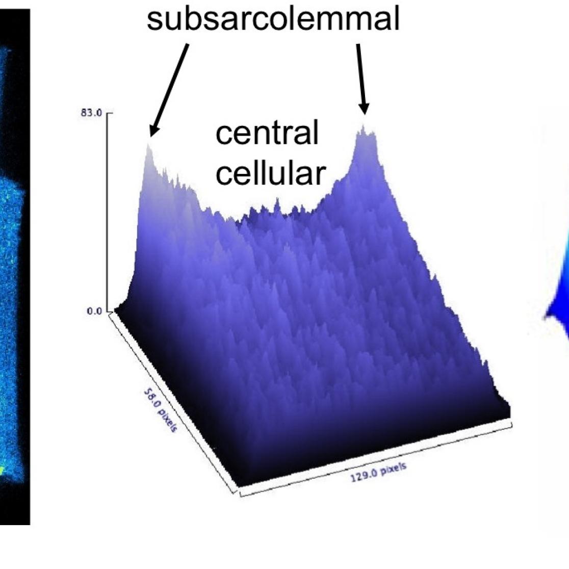 atrial_fibrillation_2