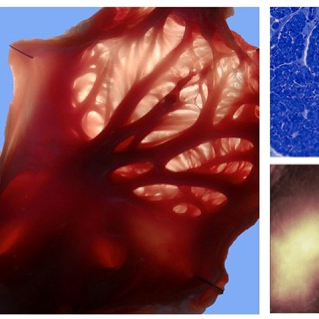 atrial_fibrillation_3