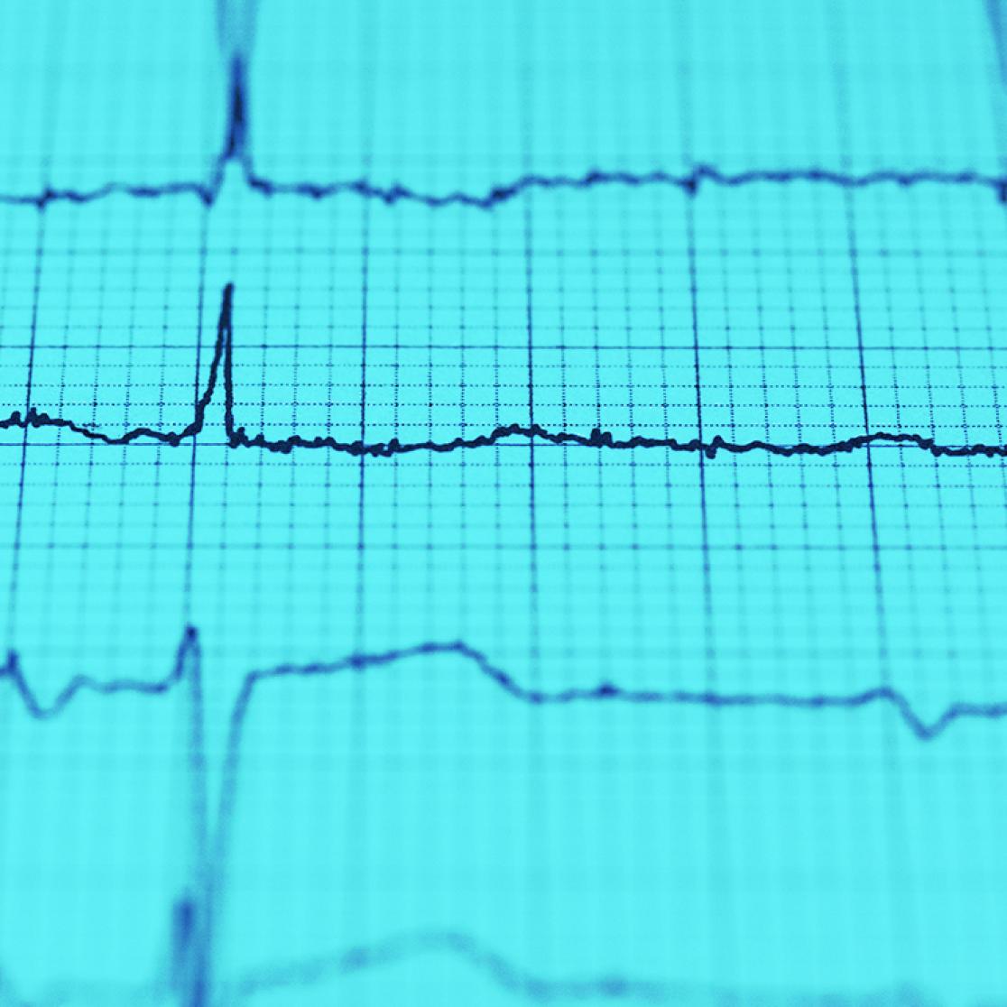 Therapeutic Delivery of miR-148a Suppresses Ventricular Dilation in Heart Failure
