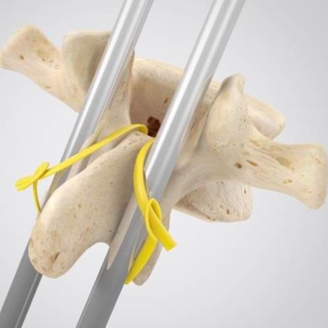 scoliose kunstof fixatiekabel