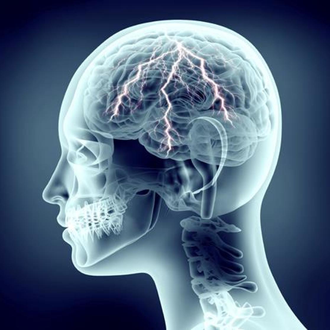 epilepsie MUMC