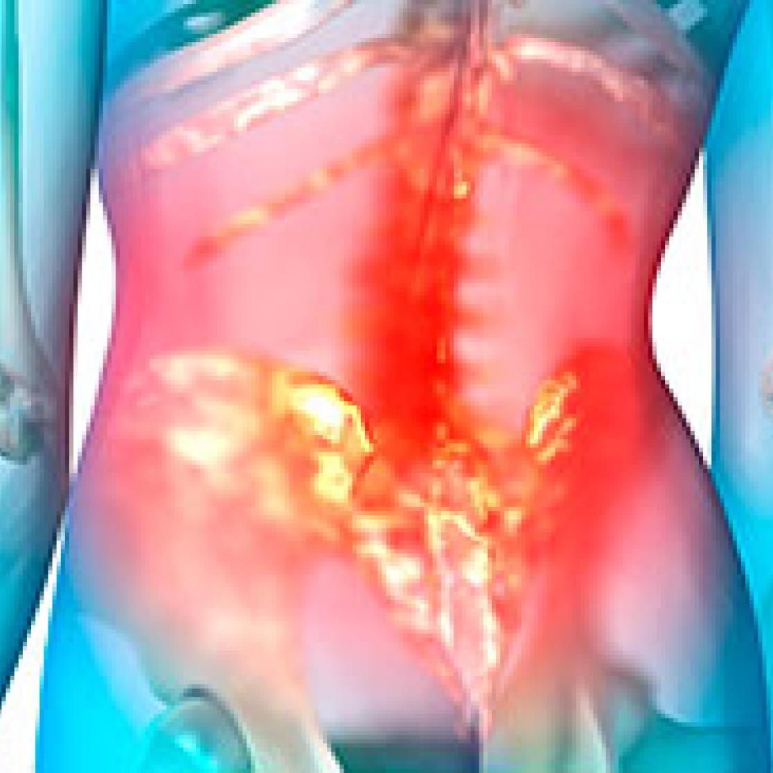 Low back pain
