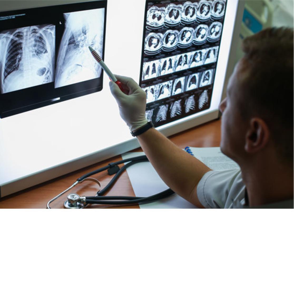 Doctor assessing a series of lung x-ray photos