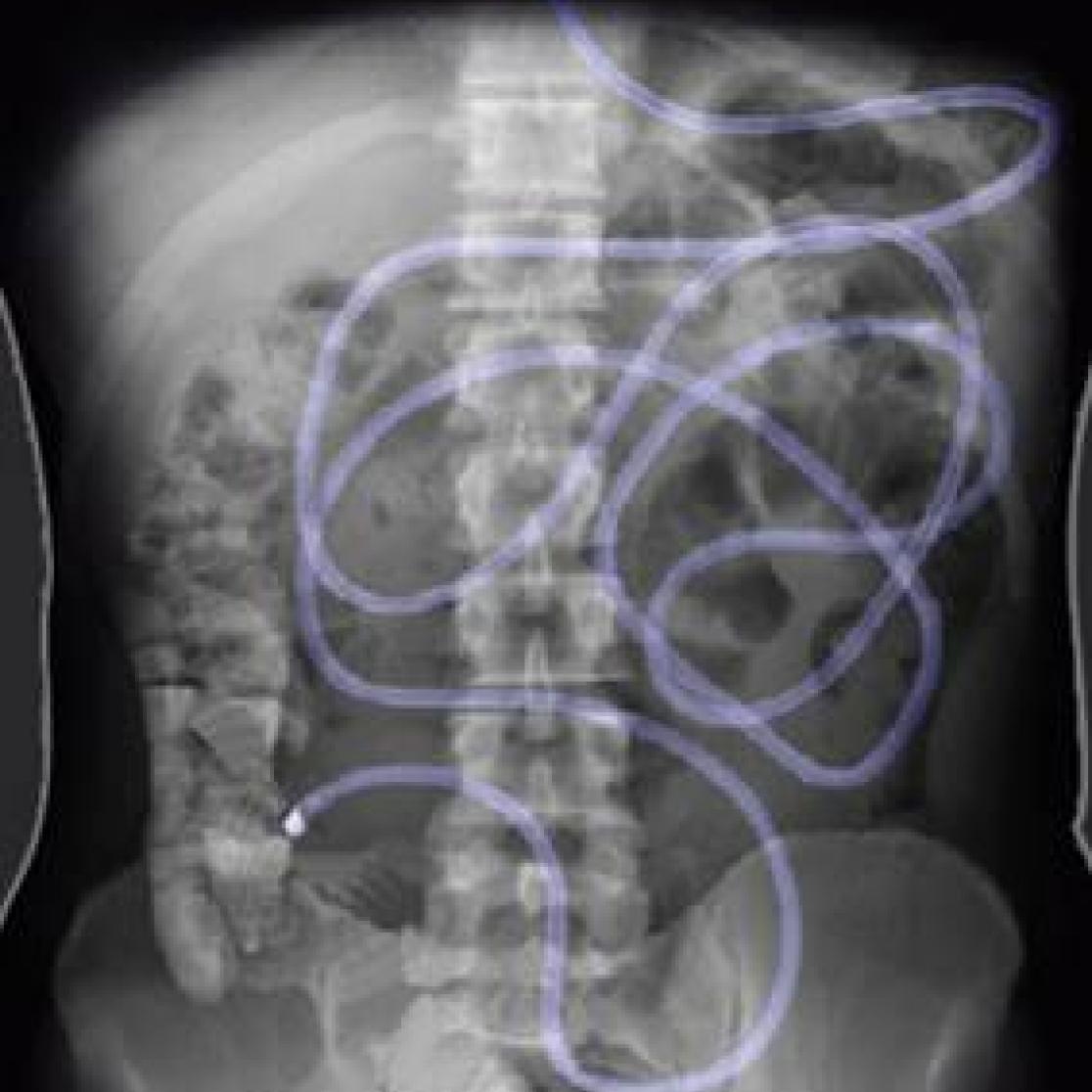 Ileal brake