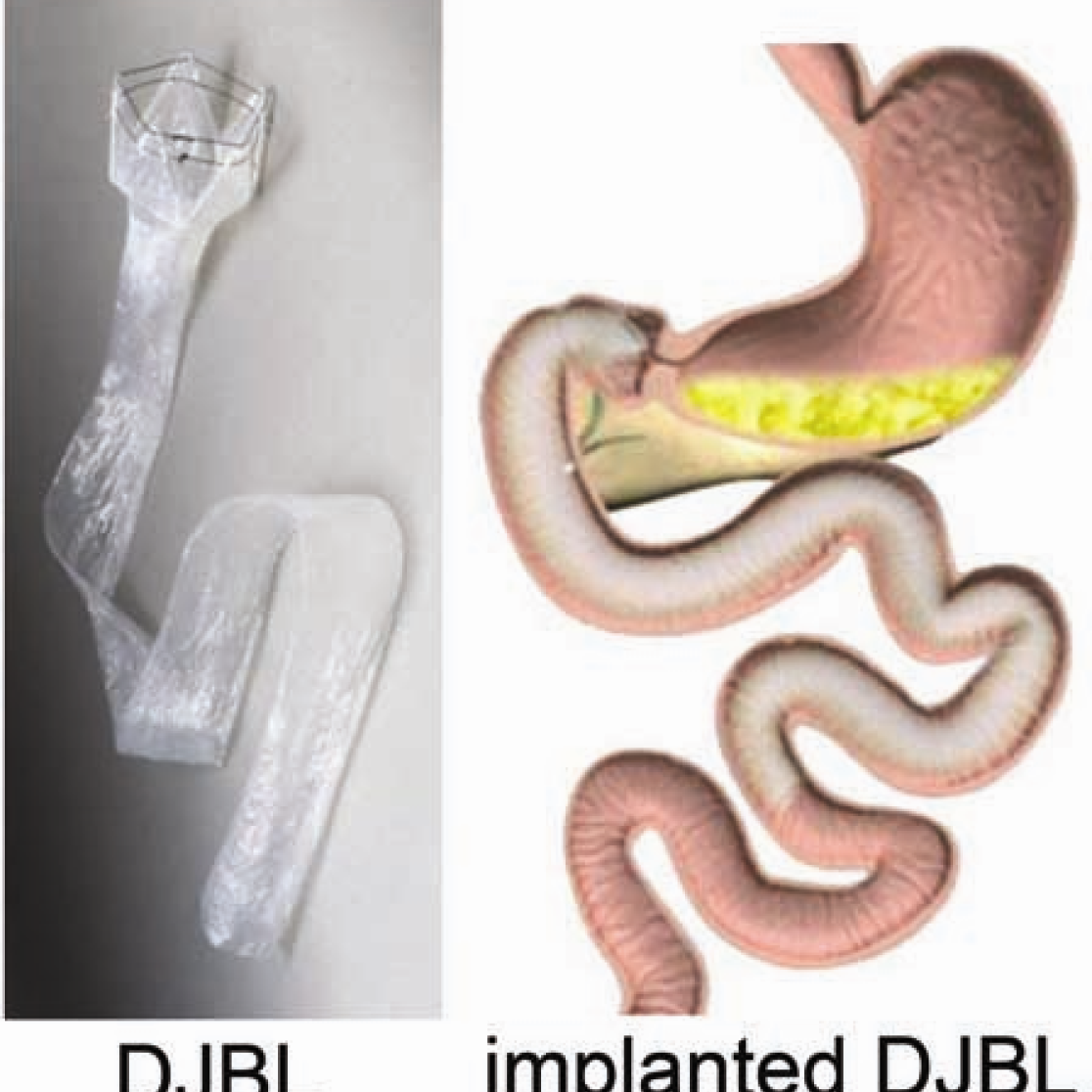 Obesity treatment