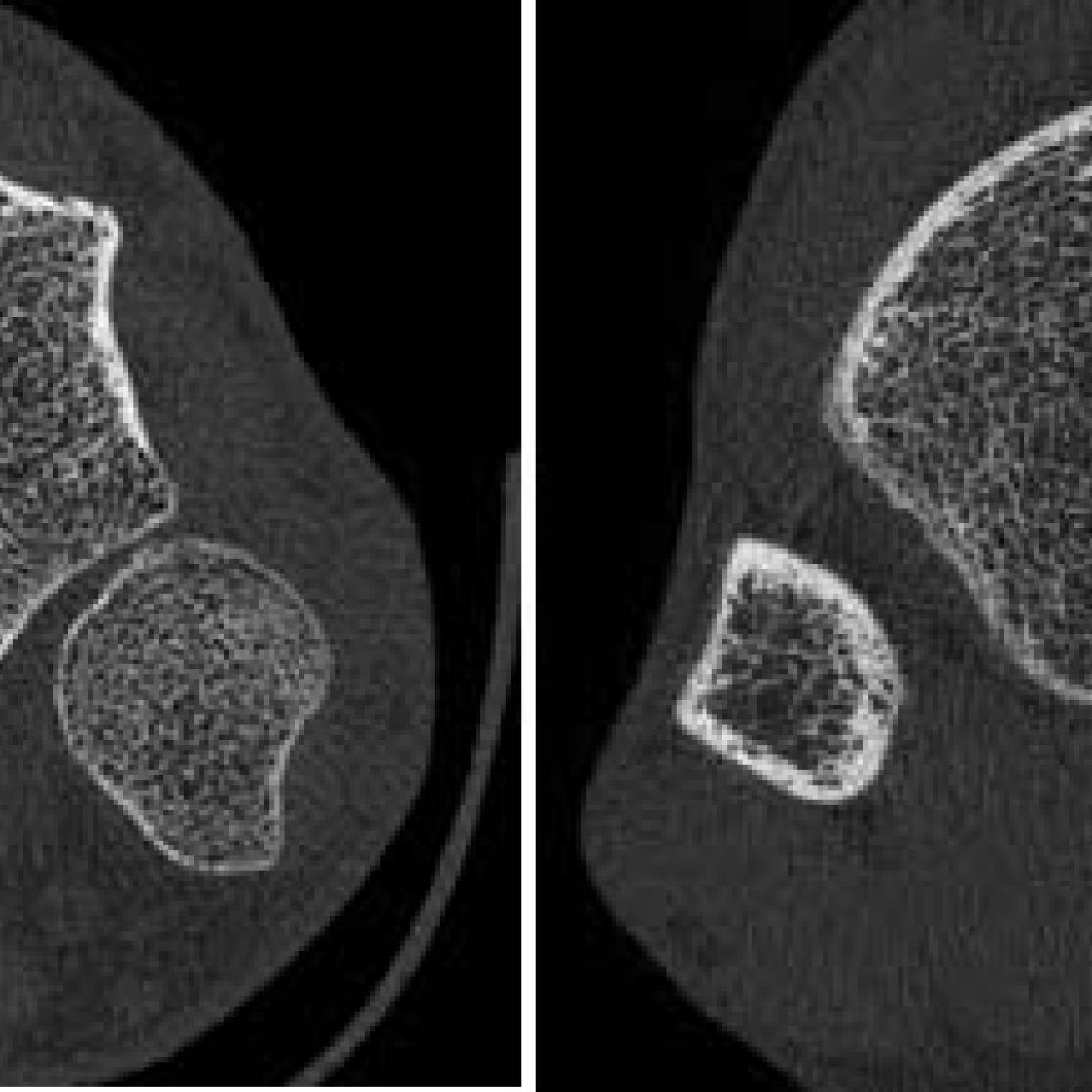 HR-pQCT images of the distal radius and tibia