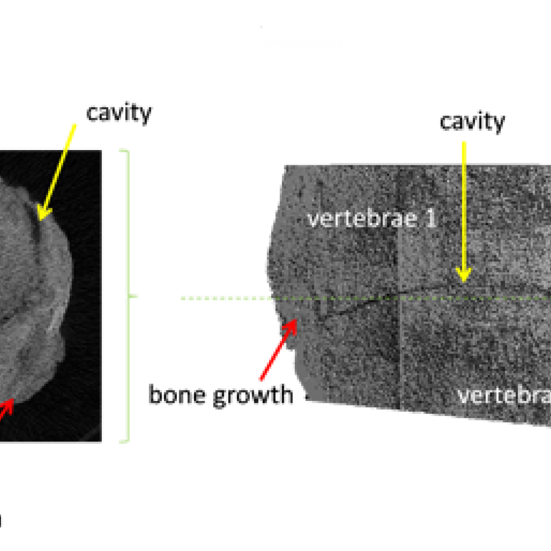 3D reconstruction of two connected vertebrae