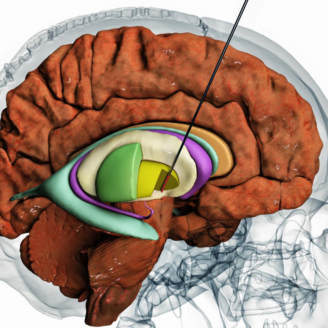 Deep Brain Stimulation