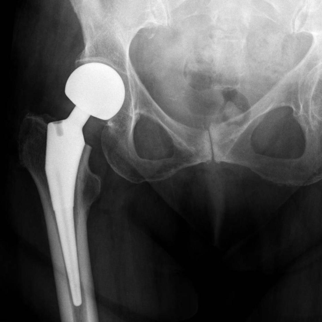 X-Ray showing hip prosthesis in left leg CC BY 4.0