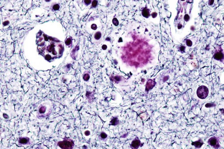 alzheimeronderzoek