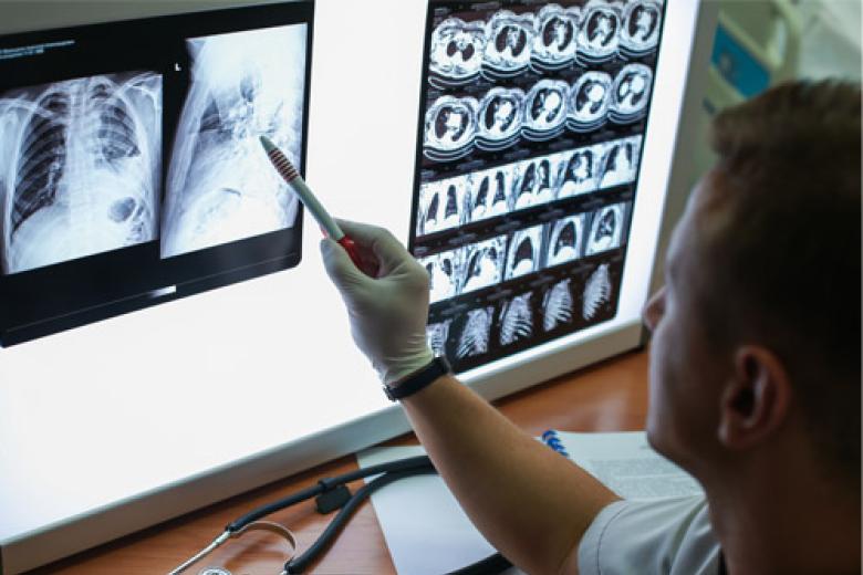 Doctor assessing a series of lung x-ray photos