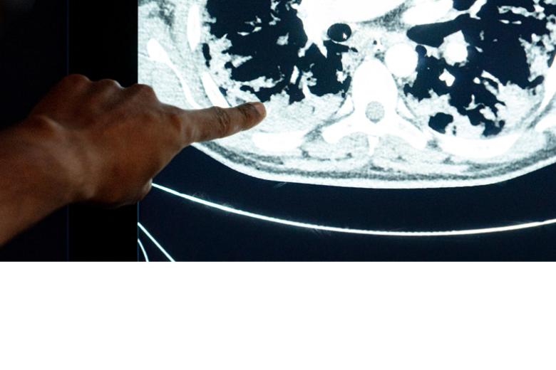 Researcher points out lung damage on mri scan