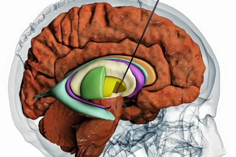 Deep Brain Stimulation