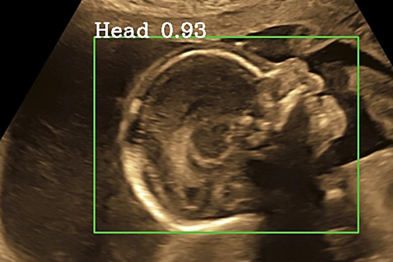 Ultrasound picture