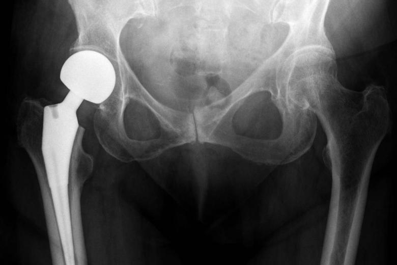 X-Ray showing hip prosthesis in left leg CC BY 4.0
